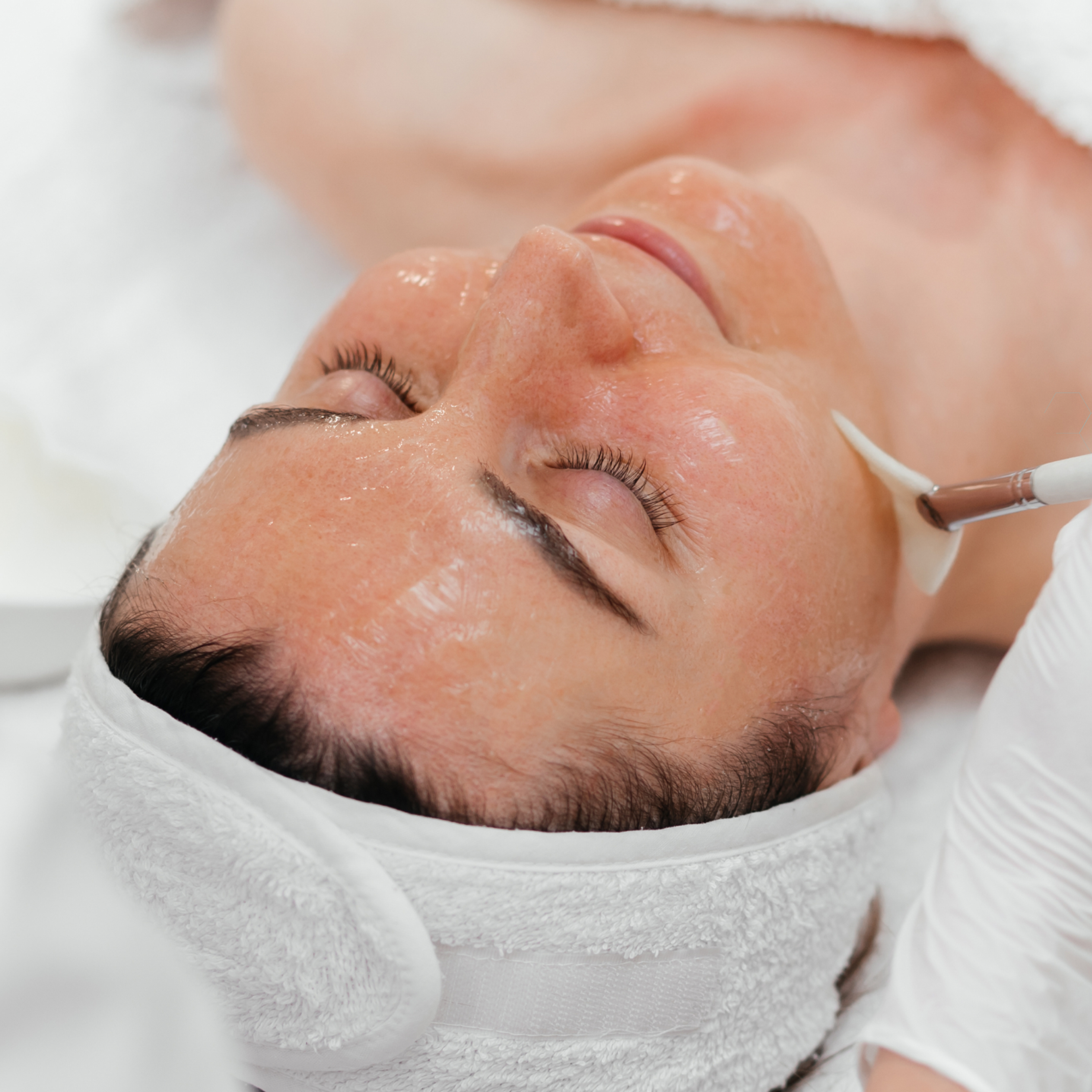 Chemical Peels